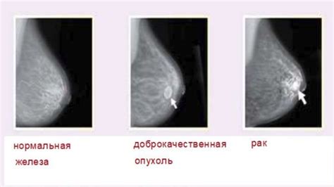 Аденома молочной железы: что это такое?