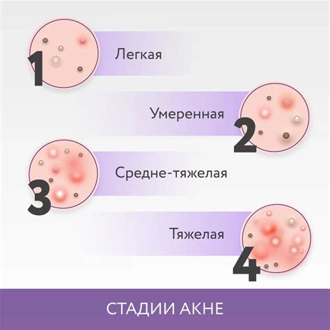 Акне