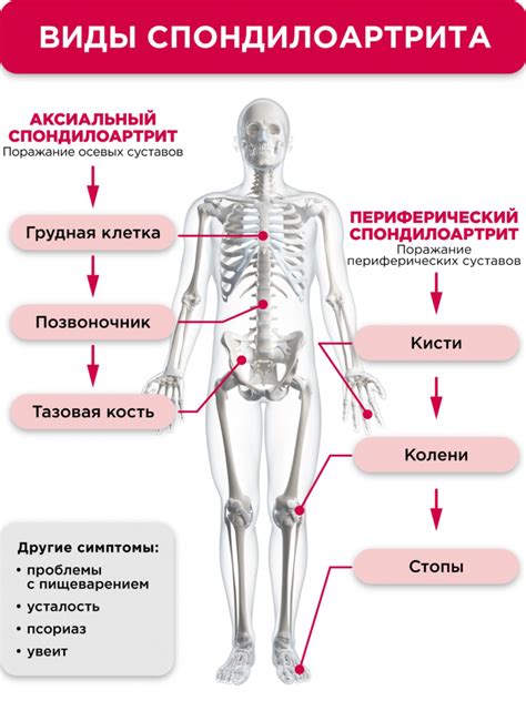 Аксиальный спондилоартрит: описание и особенности