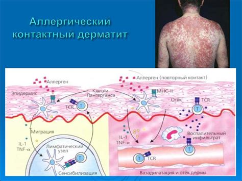 Аллергические реакции и недостаток базофилов