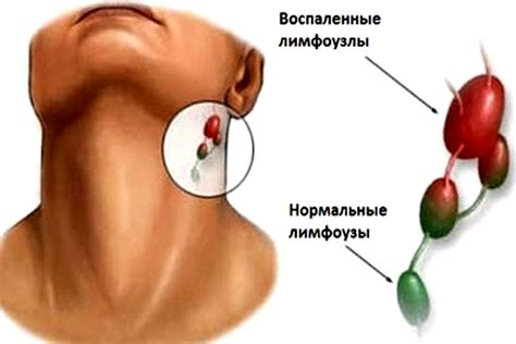 Аллергия и опухание лимфоузлов