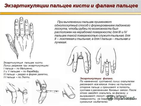 Ампутация верхней конечности близкого человека: символическое значение и толкование в сновидениях