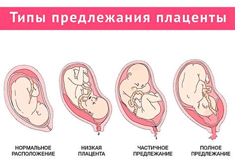 Анализ возможных замен плаценты