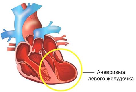 Аневризма левого желудочка сердца: симптомы, причины, лечение