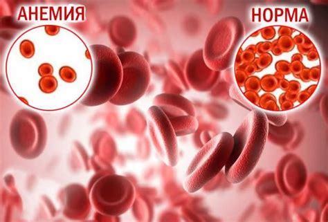 Анемия в мужском организме: влияние низкого гемоглобина