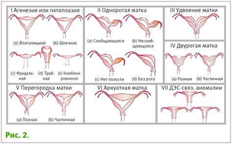 Аномалии развития матки и неполное удвоение