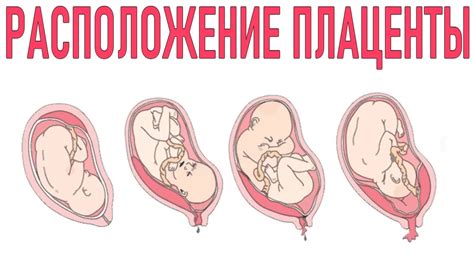 Аномалии размещения плаценты во время беременности