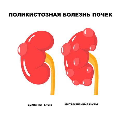 Аномалия поликистоз почек: какая связь с синусовыми кистами?