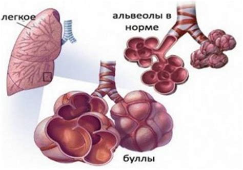 Аномальное расширение легких: что это значит?