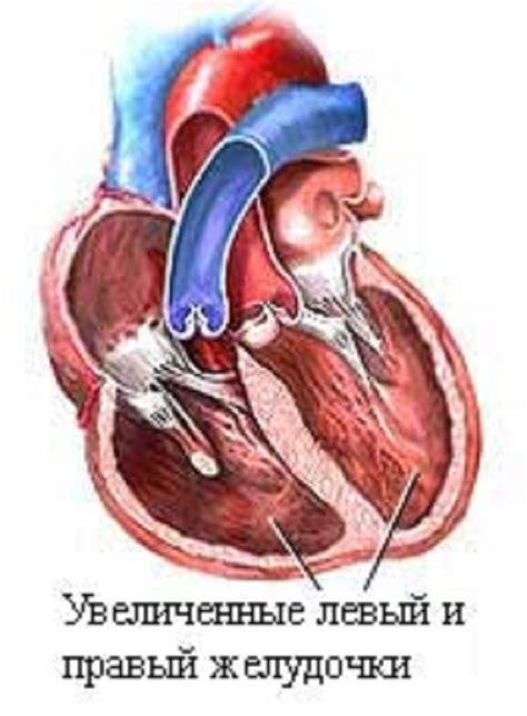 Аритмии и их связь с увеличением полости левого предсердия