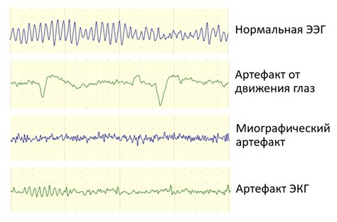 Артефакты на ЭЭГ: что это и как влияют на исследование