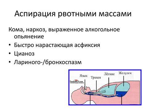 Аспирация рвотными массами