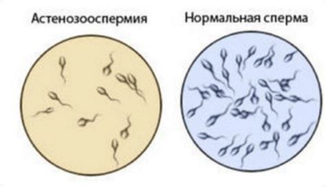 Астенозооспермия: причины, симптомы и лечение