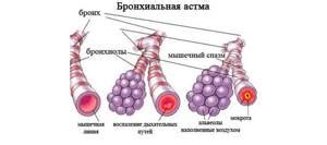 Астма и одышка