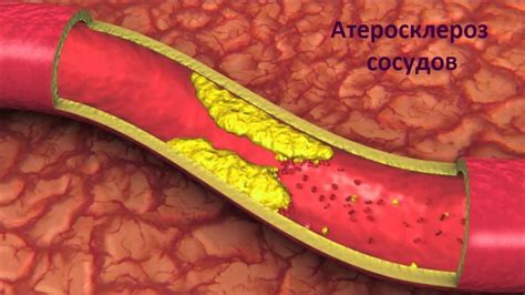 Атеросклероз и его последствия