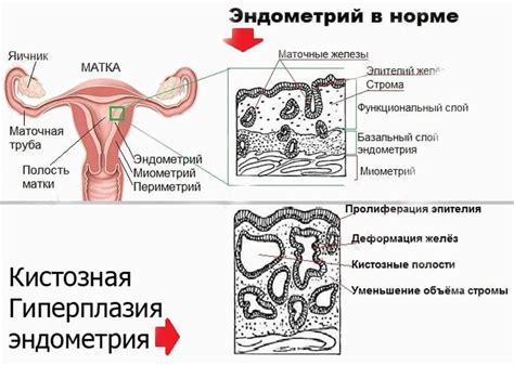 Атипическая железистая гиперплазия эндометрия