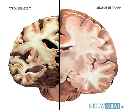 Атрофия мозга: основная информация