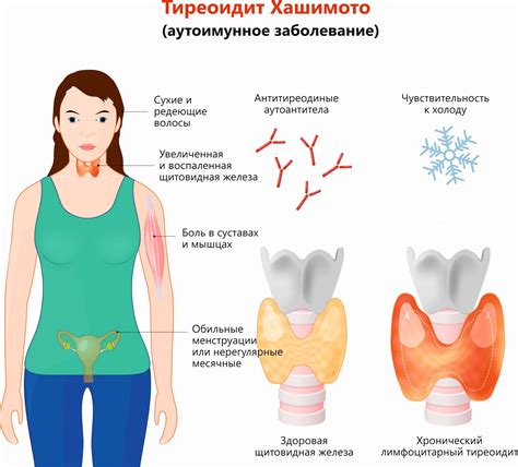 Аутоиммунный тиреоидит гипотиреоз: причины, симптомы, лечение