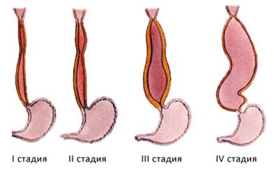 Ахалазия пищевода