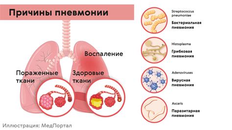 Бактериальные заболевания и пневмония