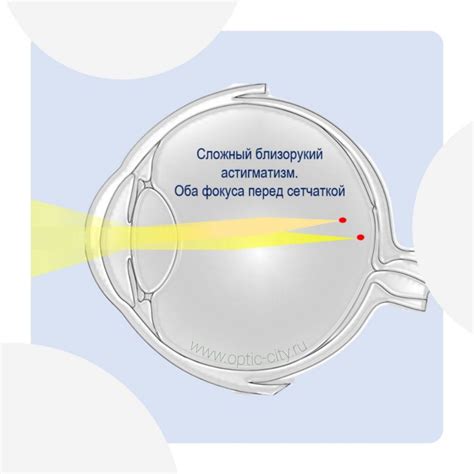 Близорукий астигматизм: особенности и проблемы
