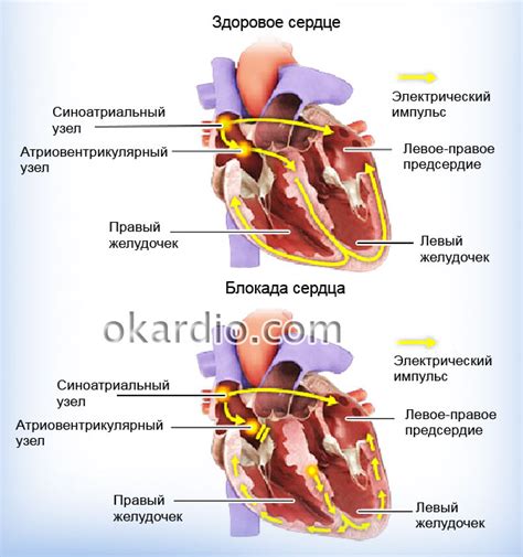 Блокада сердца