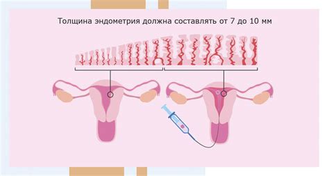 Болезненные менструации: что такое эндометрий и какой должен быть его размер