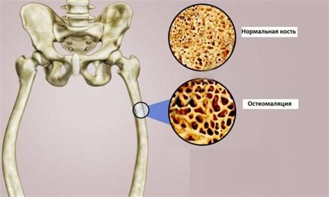 Болезни, вызывающие разрушение костей