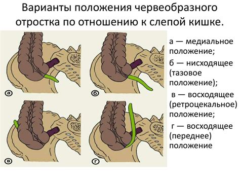 Болезни и состояния, приводящие к невизуализации червеобразного отростка