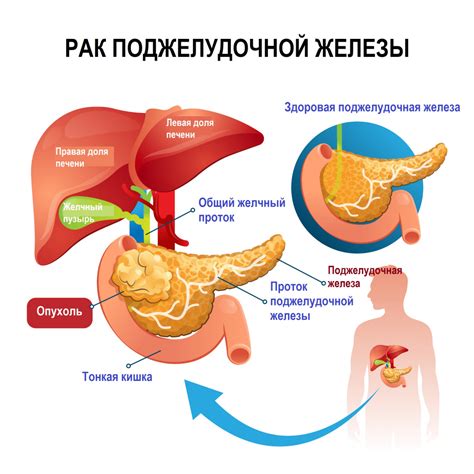 Болезнь поджелудочной железы: симптомы и причины