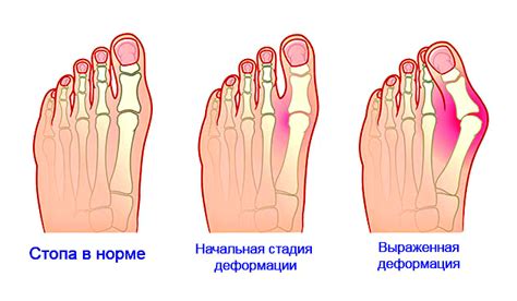 Боли в пальце ноги при неправильной обуви: как правильно подобрать обувь