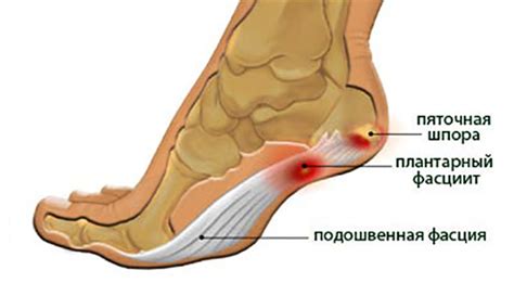Боль в пятке: причины, диагностика и лечение