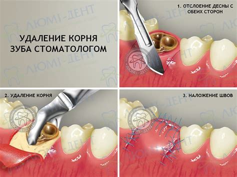 Важная информация от снов: намек от отломанного зуба без появления крови