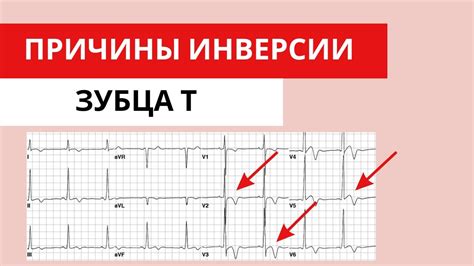 Важность обнаружения плоского зубца Т