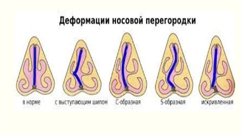 Важность определения положения носовой перегородки