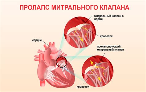 Важность регулярного обследования сердца и митрального клапана