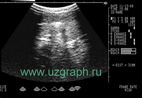 Важность результата УЗИ АИТ для диагностики и лечения