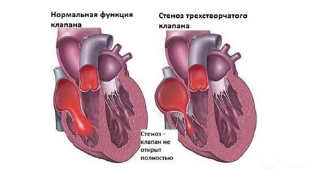 Важность трикуспидального клапана для сердечной работы