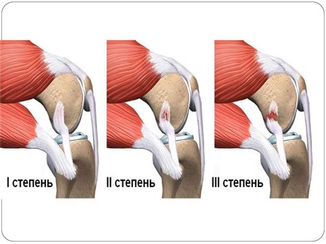 Важные аспекты при частичном повреждении связок коленного сустава