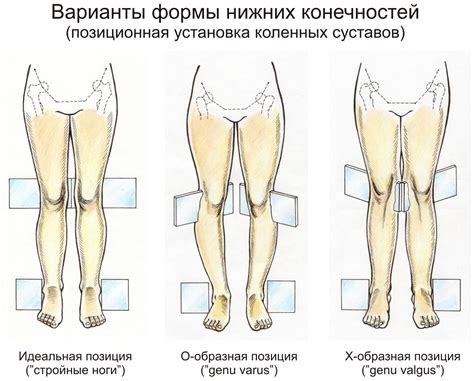 Вальгусная деформация нижних конечностей