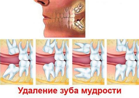 Варианты лечения гнилого зуба мудрости