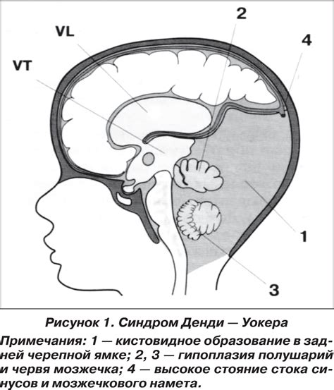 Вариант денди уокера: понятие и характеристики