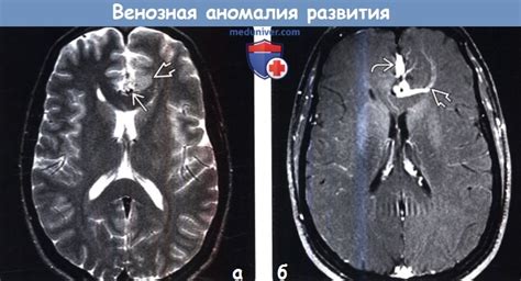 Венозная аномалия