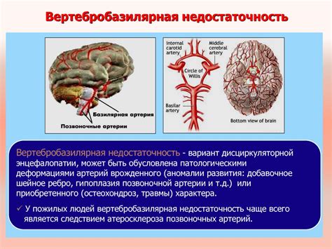 Вертебробазилярная недостаточность: что это?