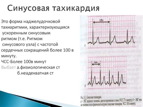 Вертикальная эос синусовой тахикардии