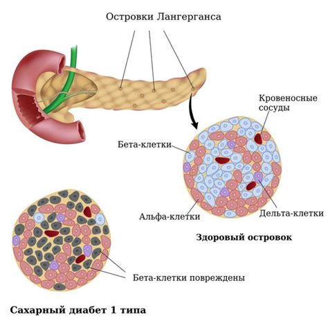 Взаимосвязь сахарного диабета и поджелудочной железы