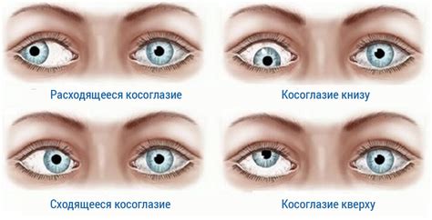 Взгляд в глубь: загадочный мир косоглазия в сновидениях