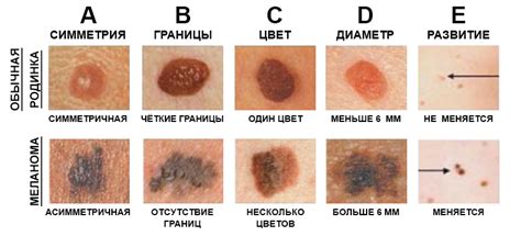 Виды внутридермальных пигментных невусов