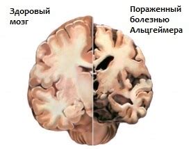 Виды деменции и их особенности