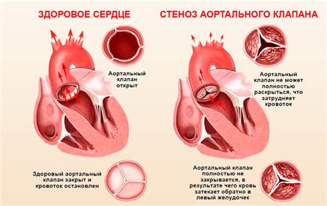 Виды закрытия клапана сердца